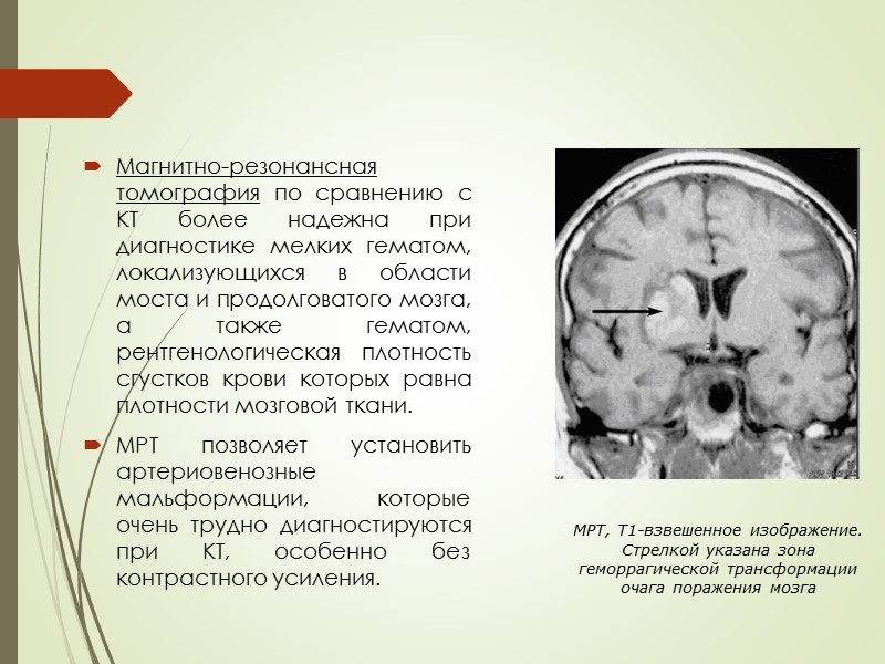 МРТ, Т1-взвешенное изображение. Стрелкой указана зона геморрагической трансформации очага поражения мозга Магнитно-резонансная томография по
